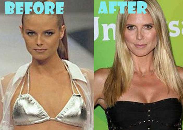 Heidi Klum Plastic Surgery