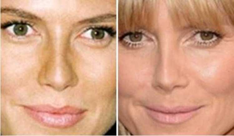 Heidi Klum Plastic Surgery