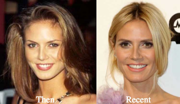 Heidi Klum Plastic Surgery