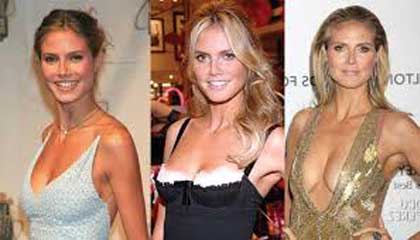 Heidi Klum Plastic Surgery