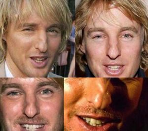 Owen Wilson Nose Job Plastic Surgery And Rhinoplasty