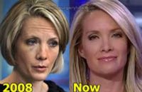 Dana Perino Plastic Surgery Facelift Nose Job Botox