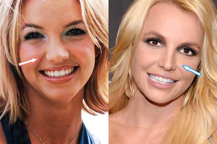 Britney Spears plastic surgeries