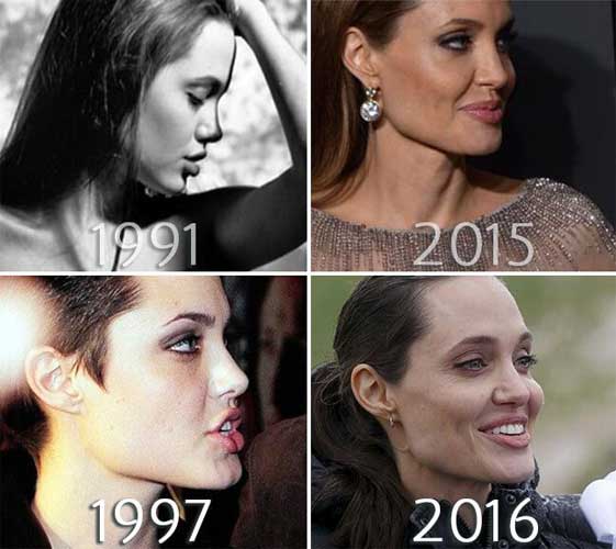 Angelina Jolie Plastic Surgery Nose Job,Chin Implant,Facelift-2073