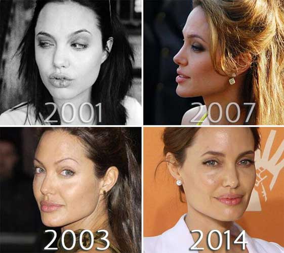 Angelina-Jolie-nose-before-and-after