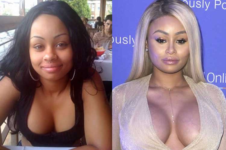 Blac Chyna Plastic Surgery