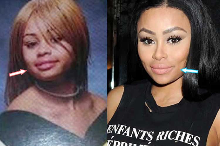 Blac Chyna Plastic Surgery