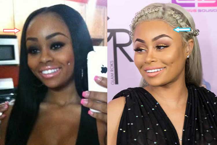 Blac Chyna Plastic Surgery