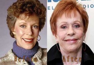 Carol Burnett Plastic Surgery Facelift, Botox Before and After Photos