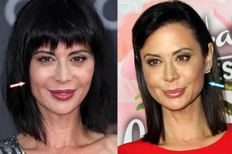 Catherine Bell Plastic Surgery