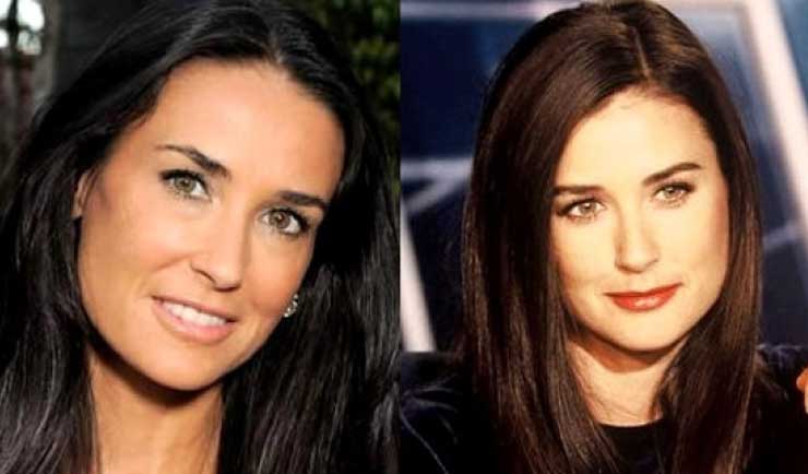 Demi Moore Plastic surgery: face,injectable filler,Botox