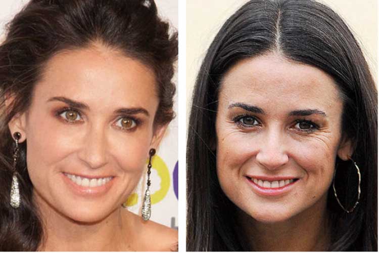 Demi Moore Plastic surgery: face,injectable filler,Botox