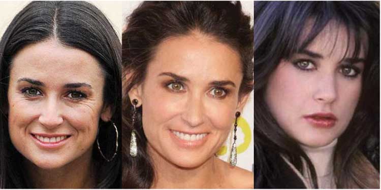 Demi Moore Plastic surgery: face,injectable filler,Botox