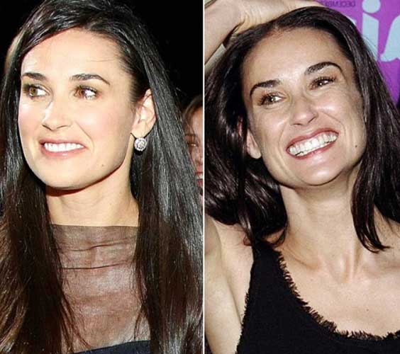 Demi Moore Plastic surgery: face,injectable filler,Botox