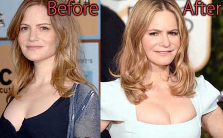 Jennifer Jason Leigh Plastic Surgery: facelifts, filler. 