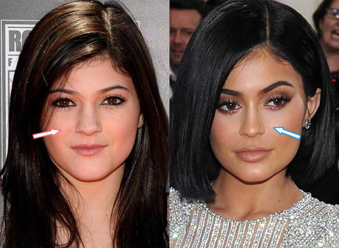 Kylie Jenner Before Plastic Surgery