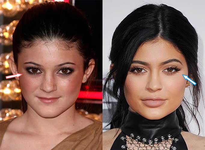 Kylie Jenner Before And After Nose Job Lip Injections Breast   Kylie Jenner Before Plastic Surgery 4 