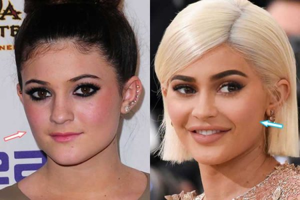 Kylie Jenner Before And After Nose Job Lip Injections Breast   Kylie Jenner Before Plastic Surgery 5 600x400 