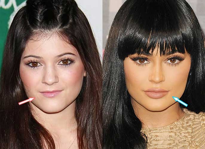 Kylie Jenner Before Plastic Surgery