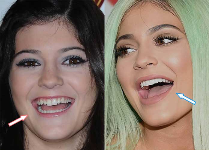 Kylie Jenner Before and after: Nose Job, Lip Injections, Breast