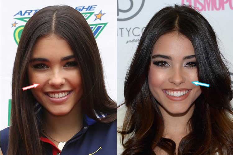 Madison Beer plastic surgery