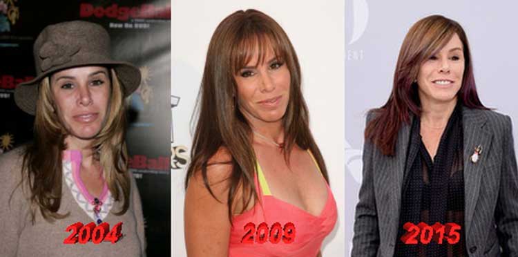 Melissa Rivers Plastic Surgery