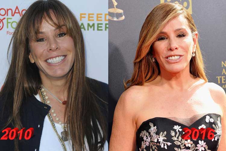 Melissa Rivers Plastic Surgery