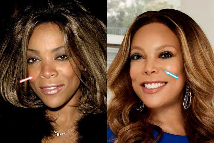 Wendy Williams Nose Job