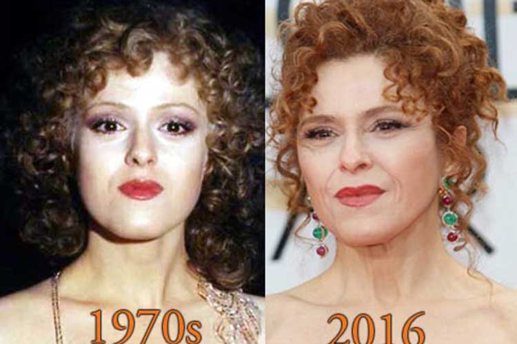 Bernadette Peters Plastic Surgery 