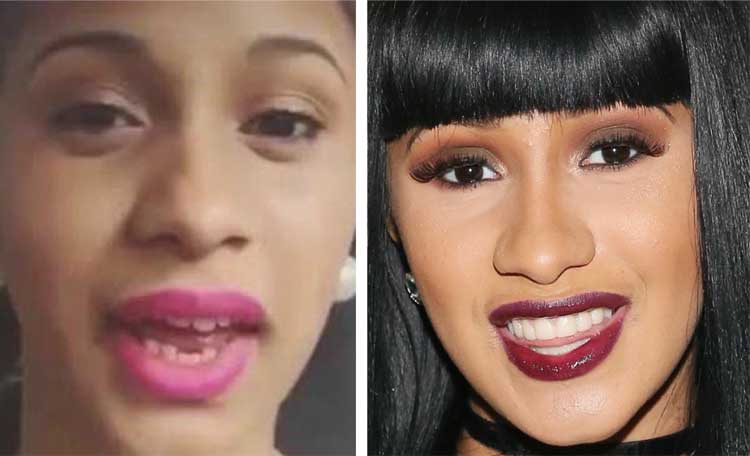 Cardi b teeth before and after