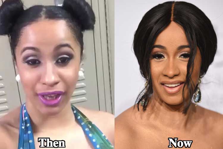 Cardi b teeth before and after