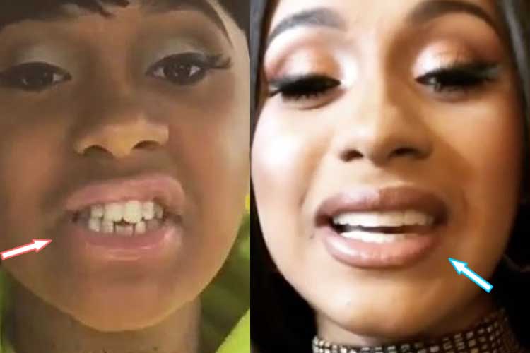 Cardi b teeth before and after