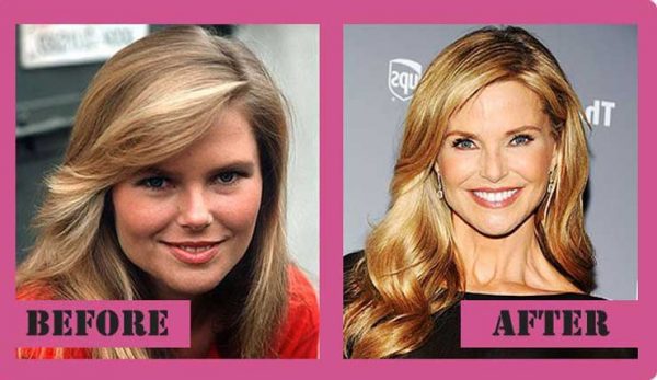 Christie Brinkley Plastic Surgery Breast Implants Botox Injections