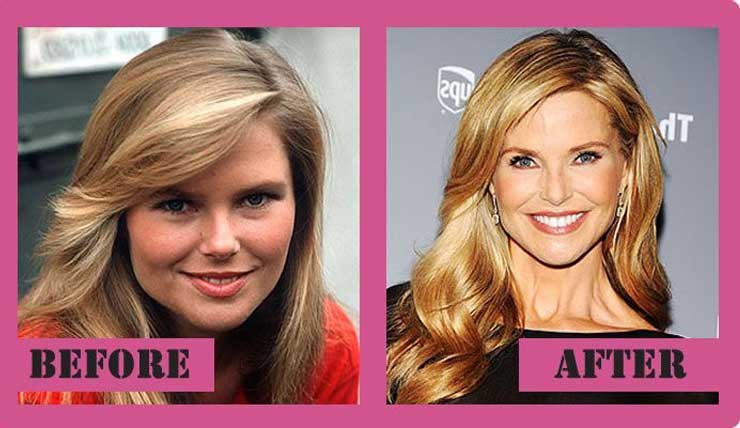 Christie Brinkley Plastic Surgery: Breast Implants, Botox Injections