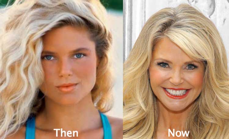 Christie Brinkley Plastic Surgery