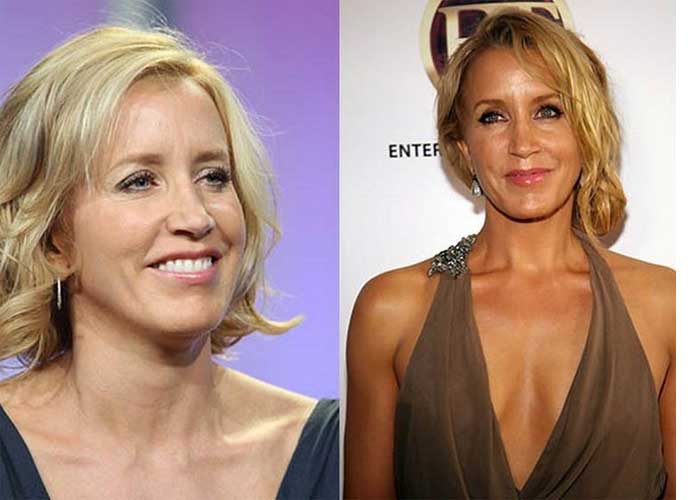 Felicity Huffman Plastic Surgery