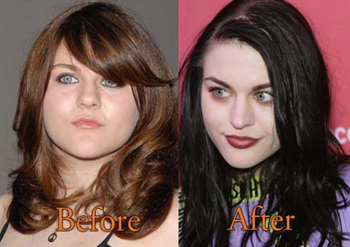 Frances bean cobain plastic surgery