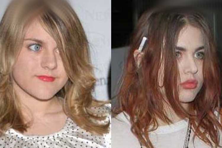 Frances bean cobain plastic surgery