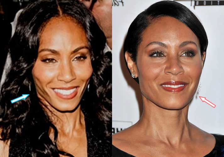 Jada Pinkett Smith plastic surgery