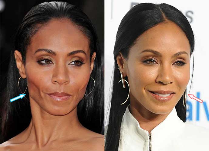 Jada Pinkett Smith plastic surgery