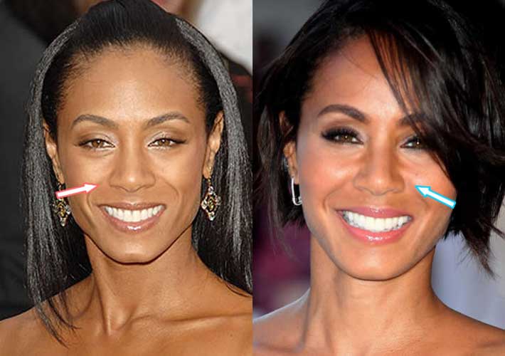 Jada Pinkett Smith plastic surgery