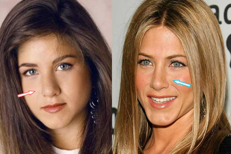 Jennifer Aniston Plastic Surgery: Nose Job, Boob Job, Botox