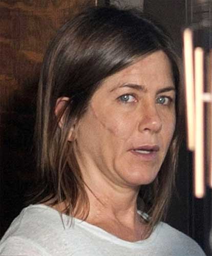 Jennifer Aniston plastic surgery