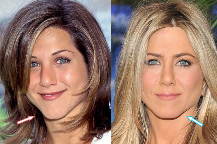 Jennifer Aniston plastic surgery