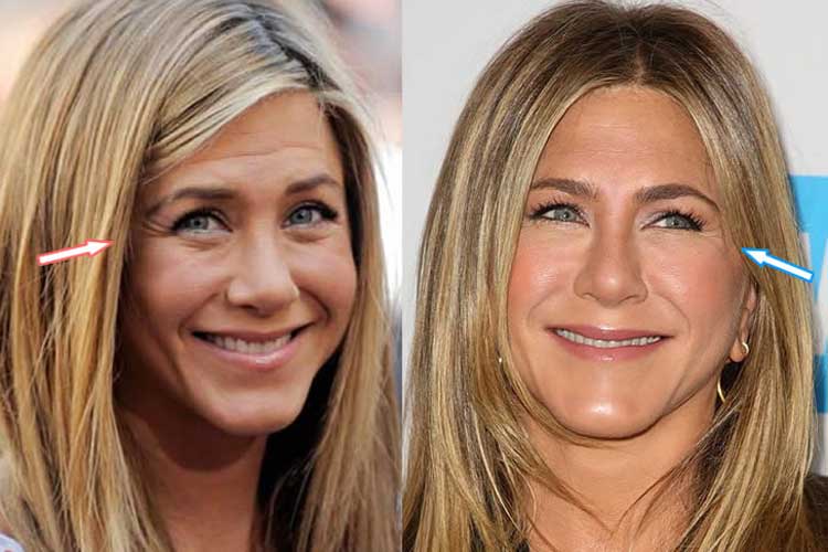 Jennifer Aniston plastic surgery