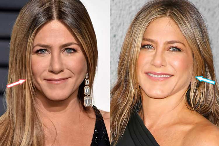 Jennifer Aniston plastic surgery