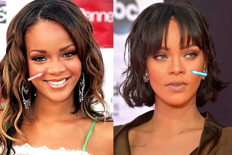 Rihanna Plastic Surgery