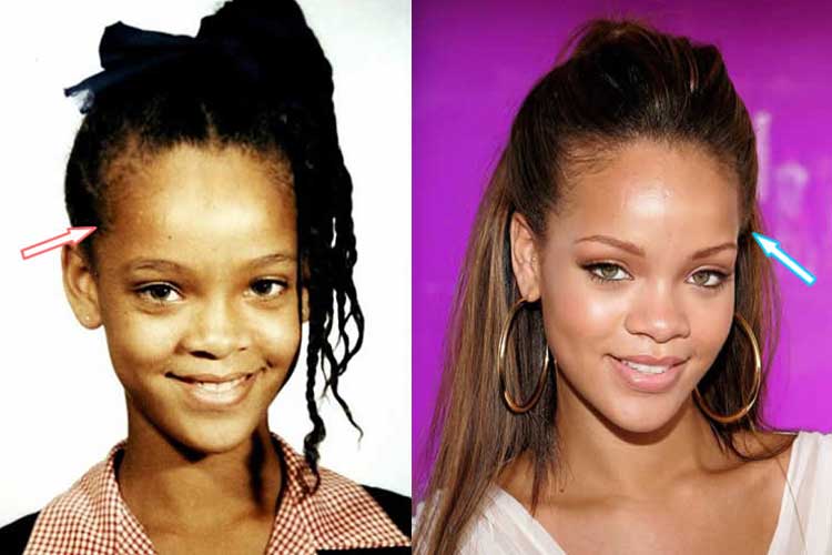 Rihanna Plastic Surgery