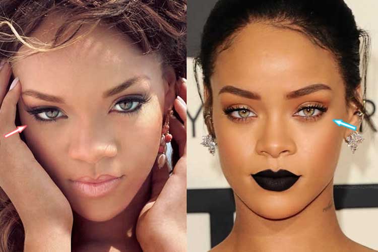 Rihanna Plastic Surgery