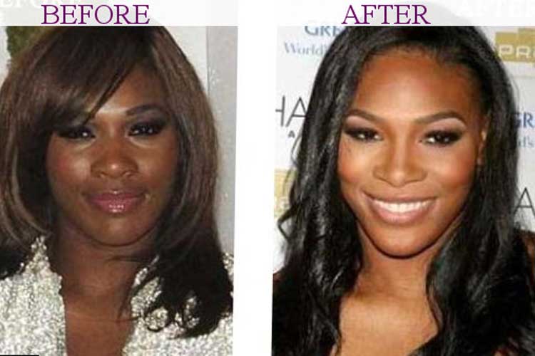 Serena Williams Plastic Surgery Nose Job, Butt and Breast augmentation